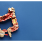 Inflammatory Bowel Disease