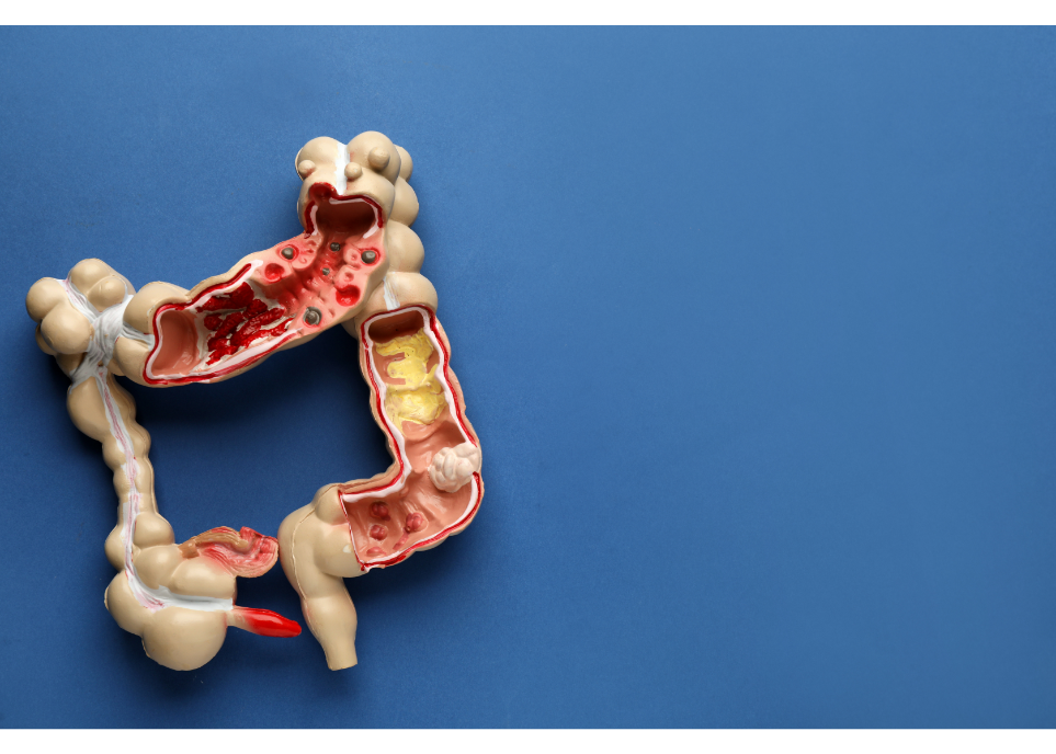 Inflammatory Bowel Disease